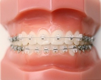 矯正治療の詳細 Of T T 歯科 矯正歯科クリニック 矯正治療の詳細 Of T T 歯科 矯正歯科クリニック